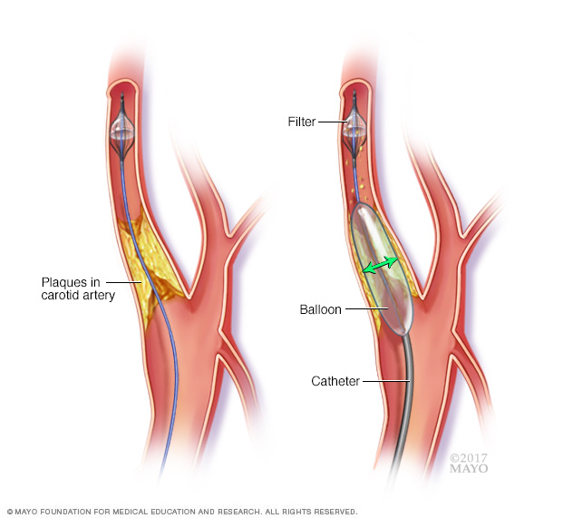 Angioplastia carotídea