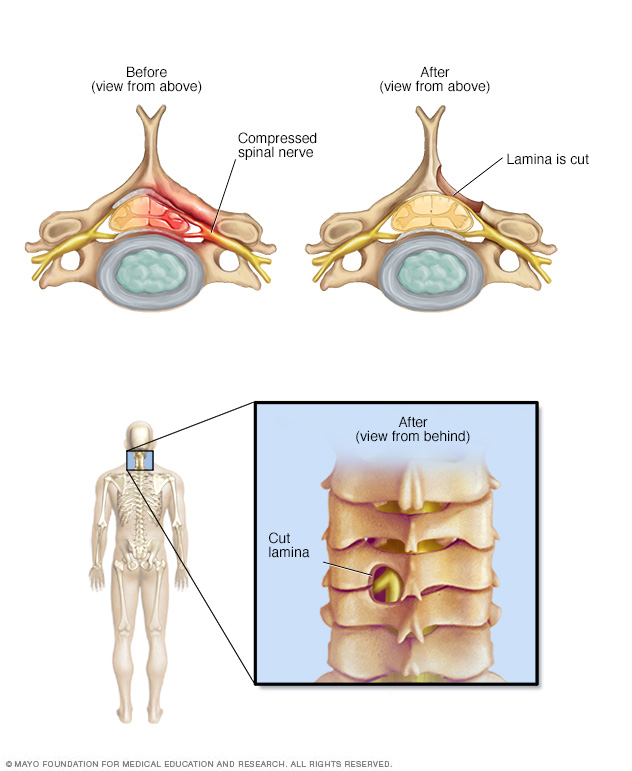 Lumbar Spinal Stenosis - Tidewater Physicians Multispecialty Group