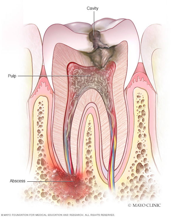 Absceso periapical