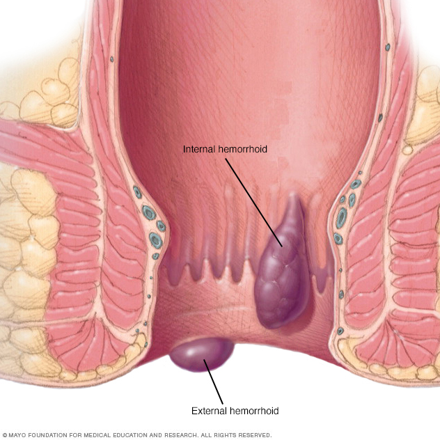 stage ii hemorrhoids internal