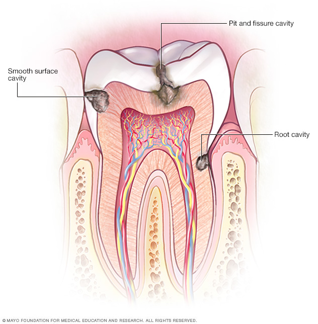 Types of cavities