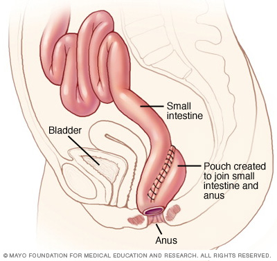 Illustration of ileoanal anastomosis 
