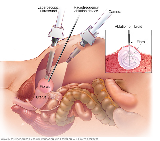 semaglutide and fibroids Uterine fibroids // Middlesex Health