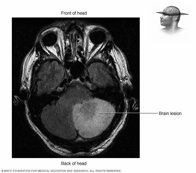 Las imágenes de la resonancia magnética muestran una lesión cerebral