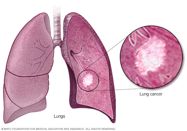 Cáncer de pulmón