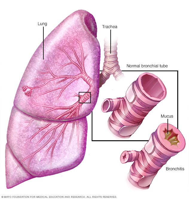 Bronquitis