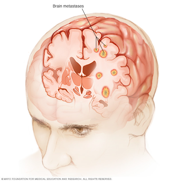 Metástasis cerebrales