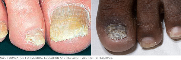 toenail polish fungus