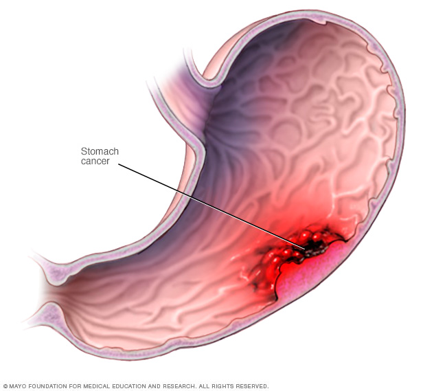 Illustration of stomach cancer 
