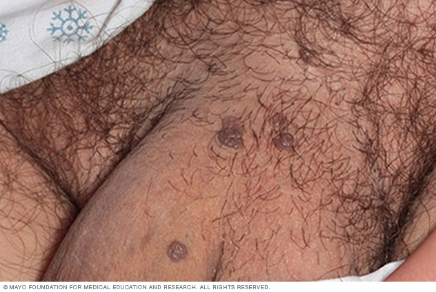 Genital warts in a man