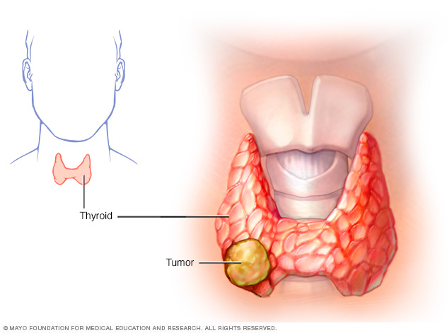 Thyroid cancer // Middlesex Health