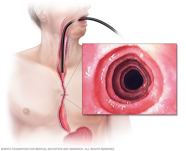 Øsofagitt eosinofil 