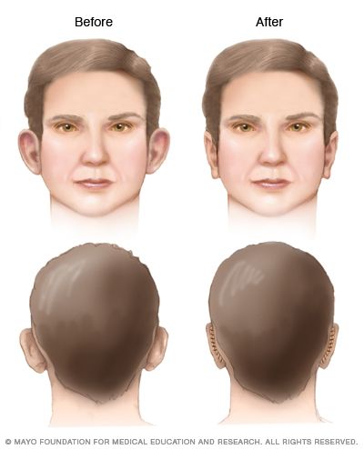 Otoplasty Middlesex Health