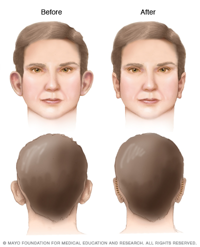 Resultados de la otoplastia