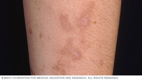 An example of a skin reaction to wild parsnip