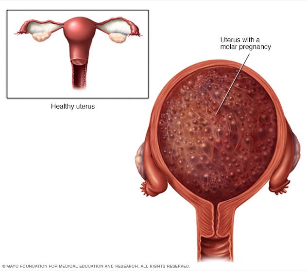 Molar pregnancy