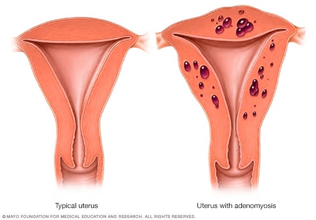 Normal uterus vs. uterus with adenomyosis