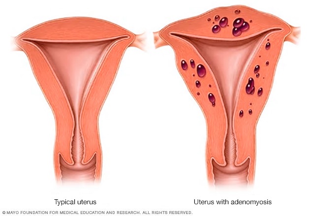 Útero normal y útero con adenomiosis