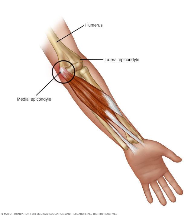 Illustration of golfer's elbow
