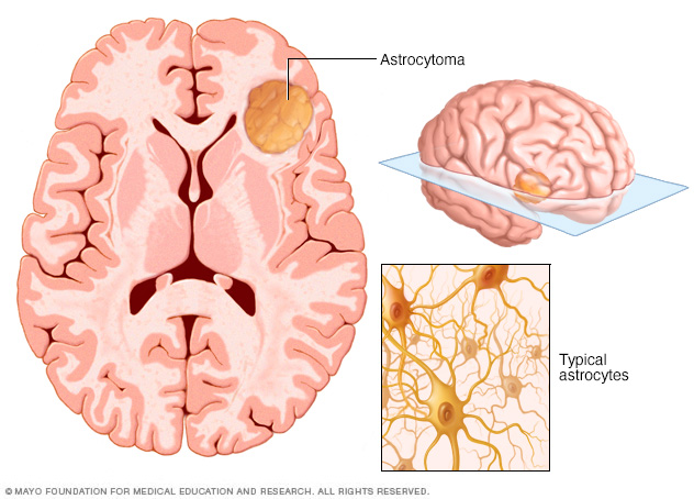 A brain with an astrocytoma brain tumor and normal astrocyte cells