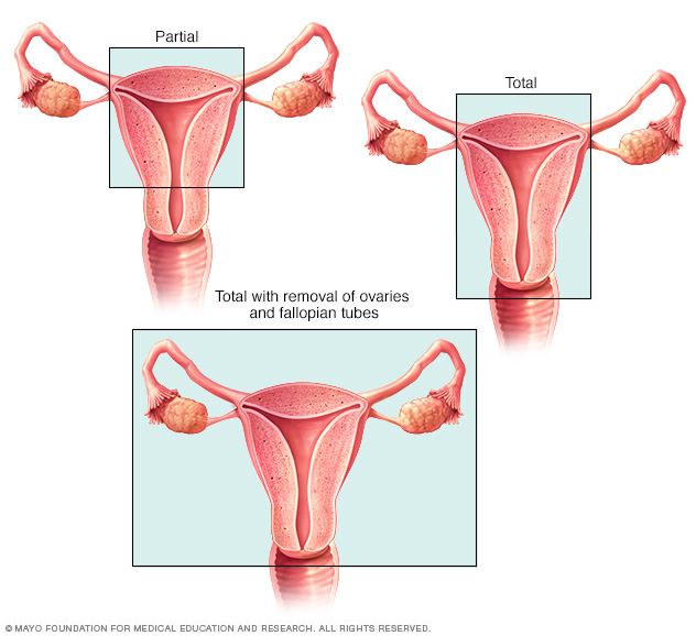 Tipos de histerectomía