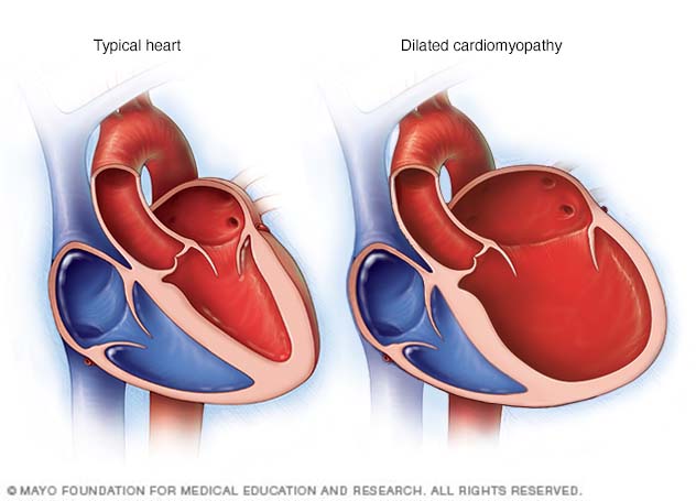 Cardiomiopatía dilatada