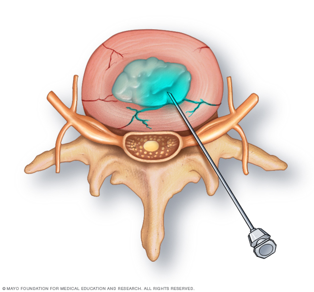 Inyección de un medio de contraste en un disco vertebral 