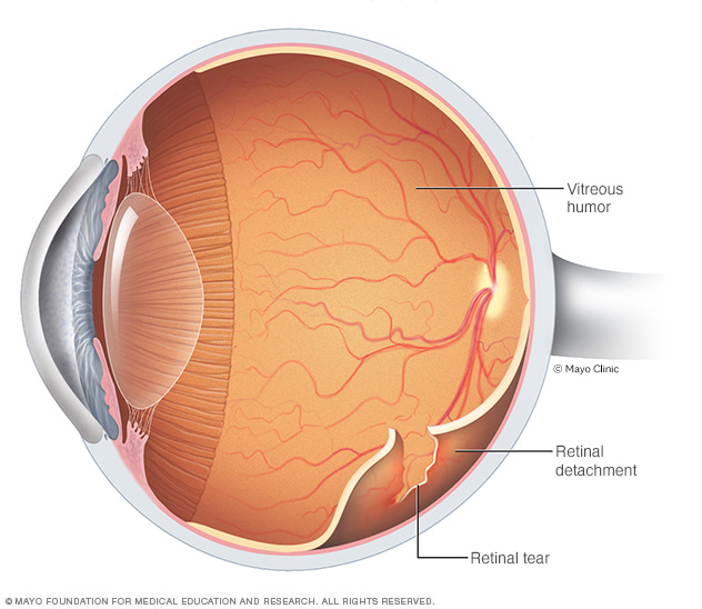 Retinal detachment