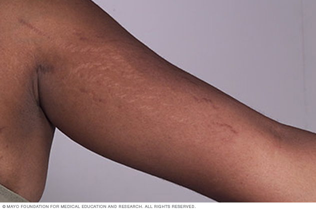 Stretch marks on arm