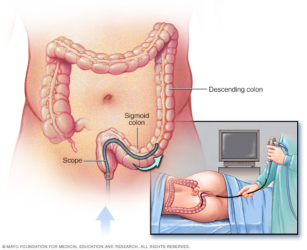 Inflammatory Bowel Disease Ibd Middlesex Health