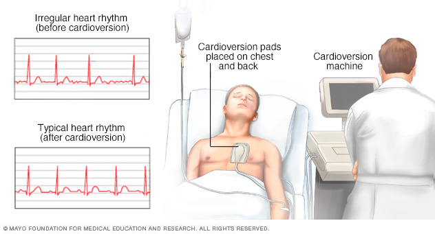 Person undergoing cardioversion 