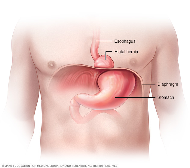 Gastroesophageal reflux disease (GERD) // Middlesex Health