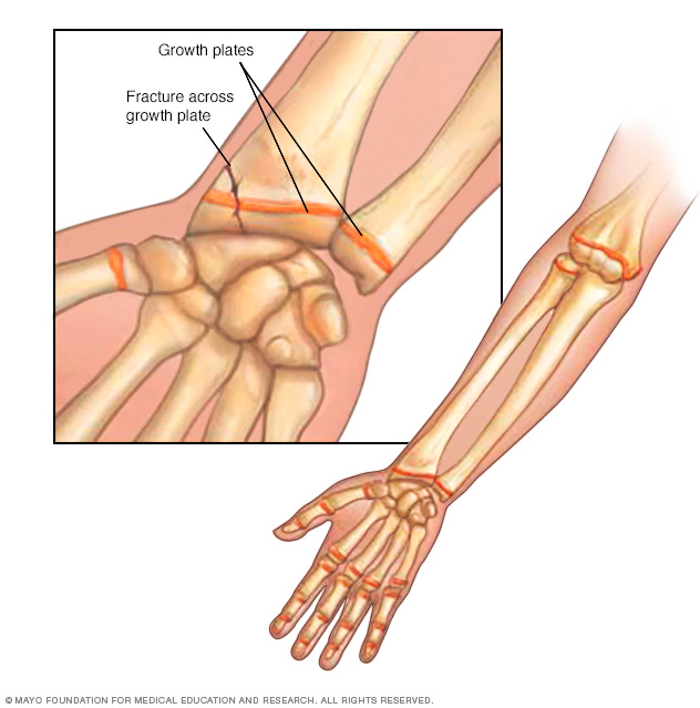 Illustration of a growth plate fracture 
