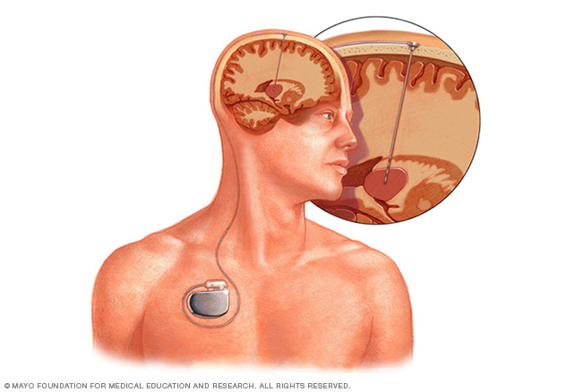 Estimulación cerebral profunda