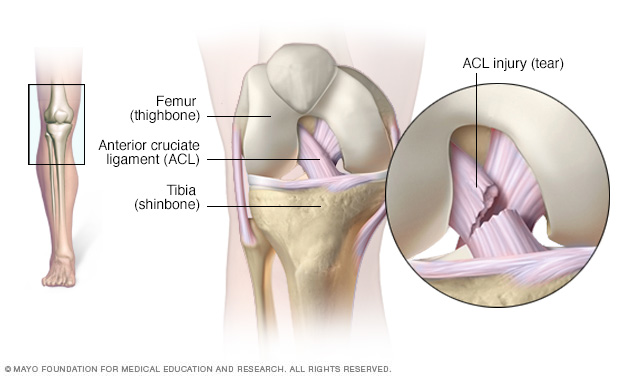 Ligamentul încrucișat anterior