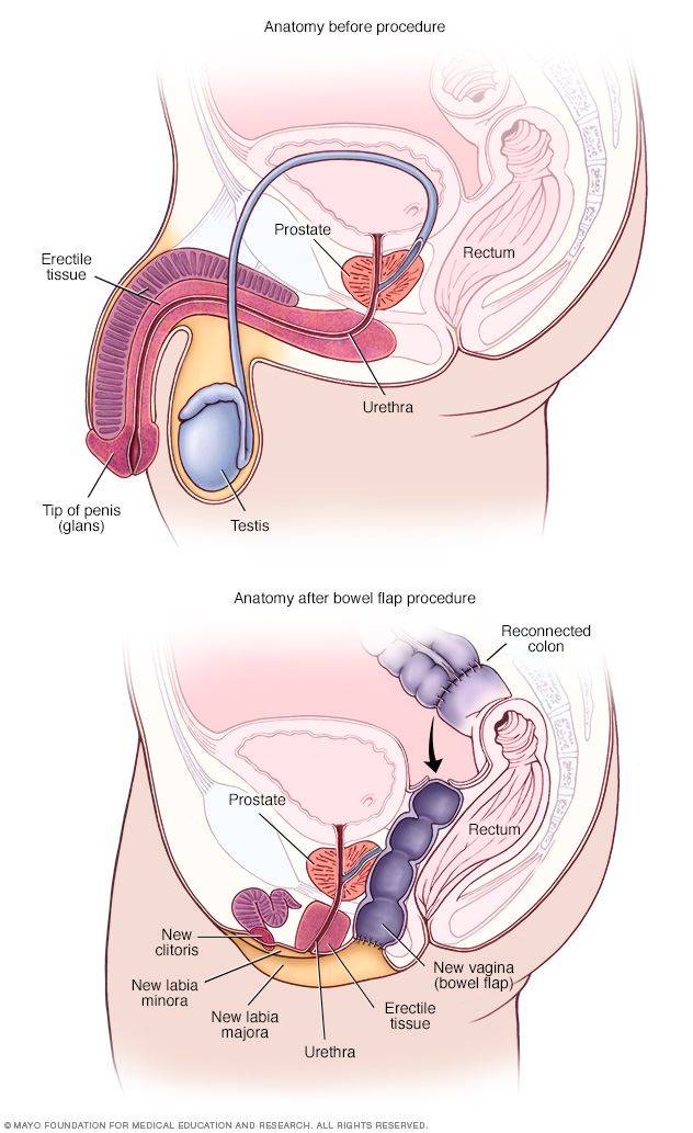 Anatomy before and after bowel flap procedure