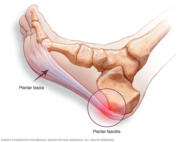 Fascitis plantar: cómo prevenir y tratar el dolor en la planta del pie - UPP