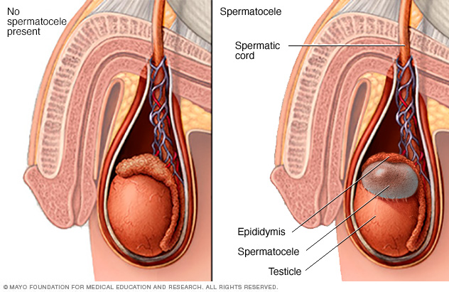 Spermatocele Middlesex Health