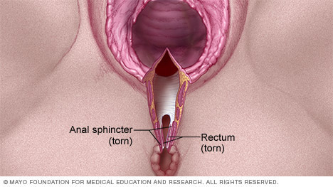 Ilustración de un desgarro vaginal de cuarto grado