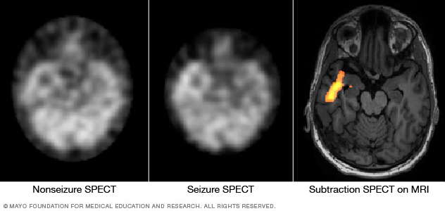 Exploraciones del cerebro para determinar el &aacute;rea donde ocurre la convulsi&oacute;n