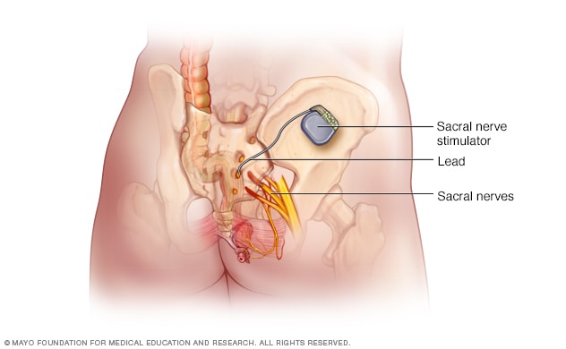 Dispositivo de estimulación del nervio sacro