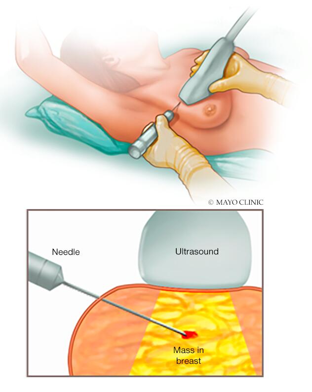 Core needle biopsy