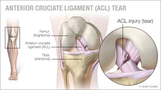 Anterior cruciate ligament