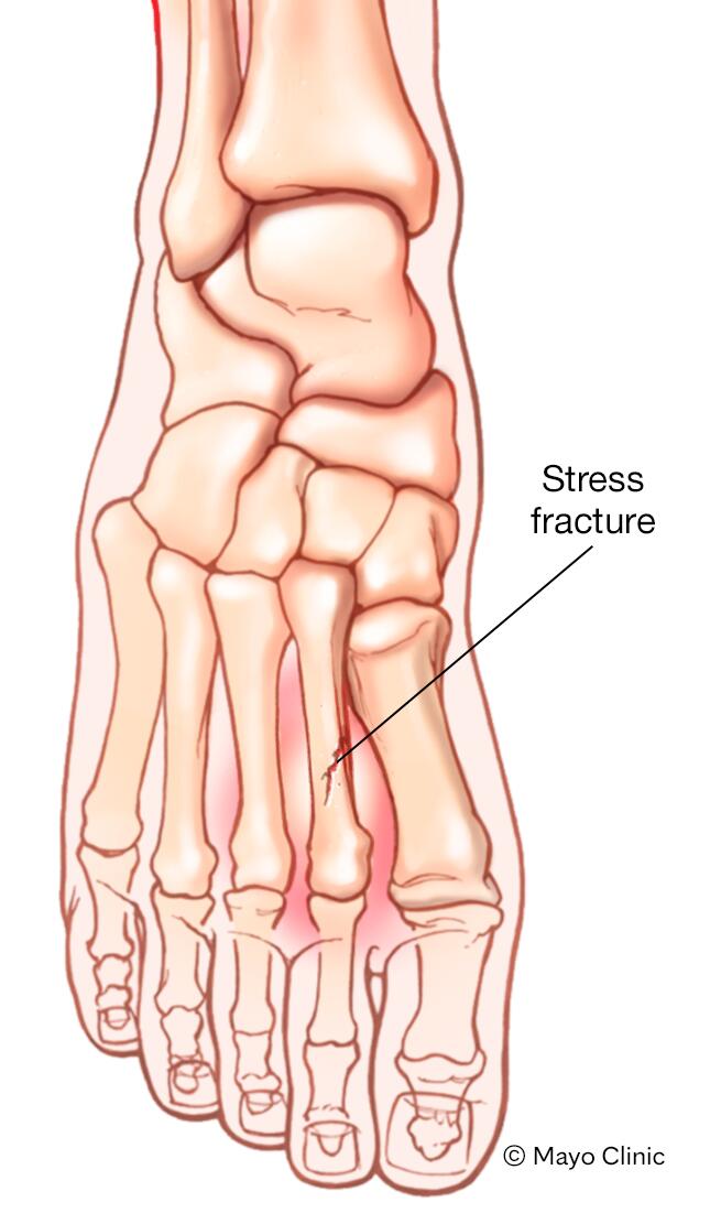 How Painful are Stress Fractures? Understanding the Agony
