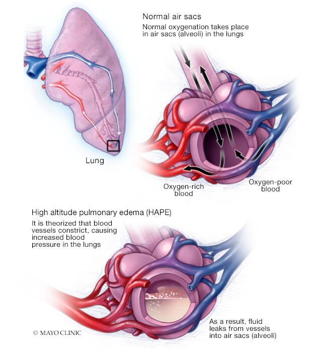 Edema pulmonar de las alturas