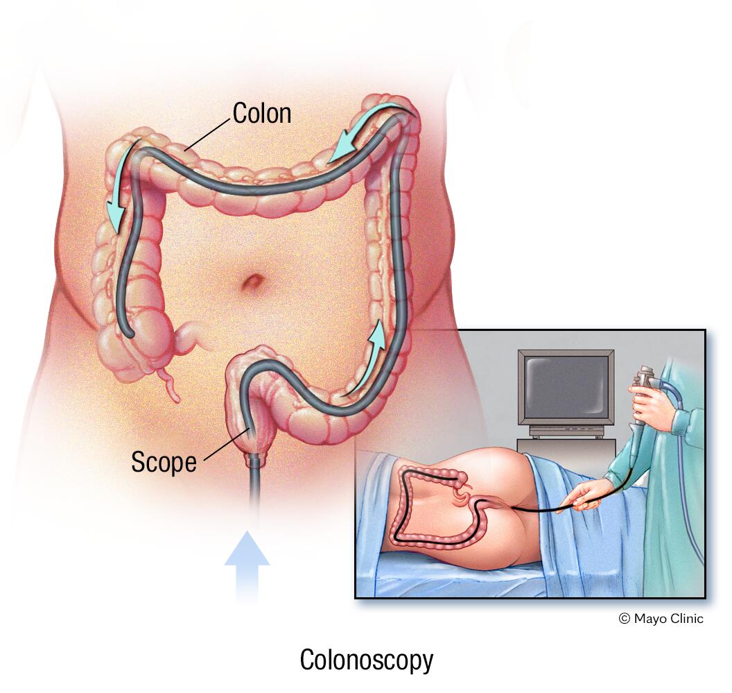 Examen de colonoscopia