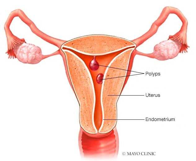 Uterine polyps