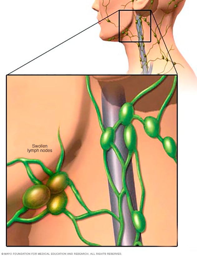 Swollen lymph nodes