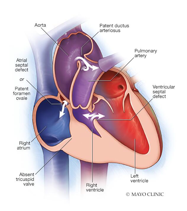 Tricuspid atresia