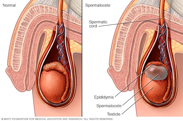 Espermatocele